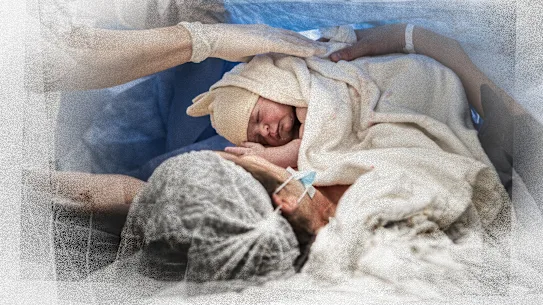 Quarante et un pour cent des mères australiennes accouchent désormais par césarienne.