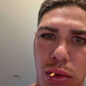 Reece Walsh a publié une photo de sa pommette fracturée sur Instagram.