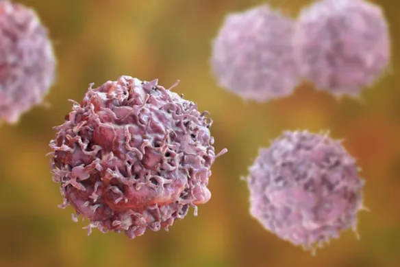 Même parmi les tumeurs solides difficiles à traiter, le cancer du pancréas est unique en termes de mécanismes de survie.