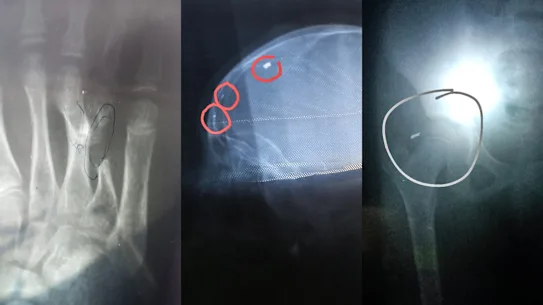 Radiographies montrant l'état de santé de la fille de neuf ans de Hodan Abby. 