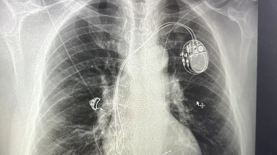 Une radiographie de la poitrine de Fotis Kapetopoulos après l'installation d'un stimulateur cardiaque.