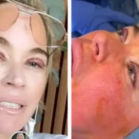 Teddi Mellencamp a subi une chirurgie esthétique lorsqu&rsquo;elle suivait une chimio. j&rsquo;ai fait pareil